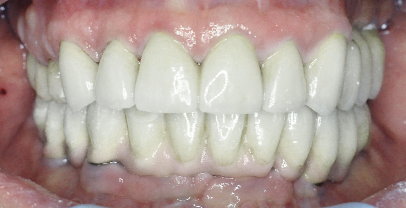 denti dopo un impianto dentale Lodi