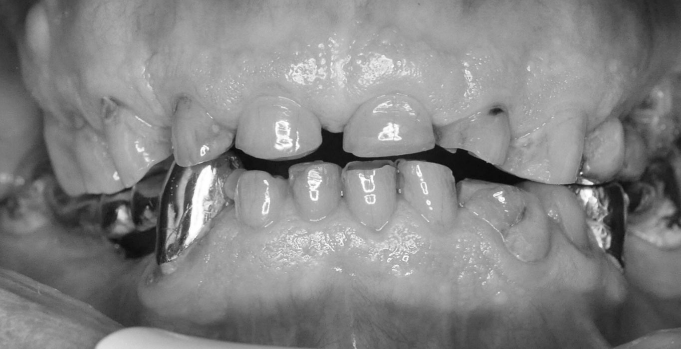 denti prima di un impianto dentale lodi