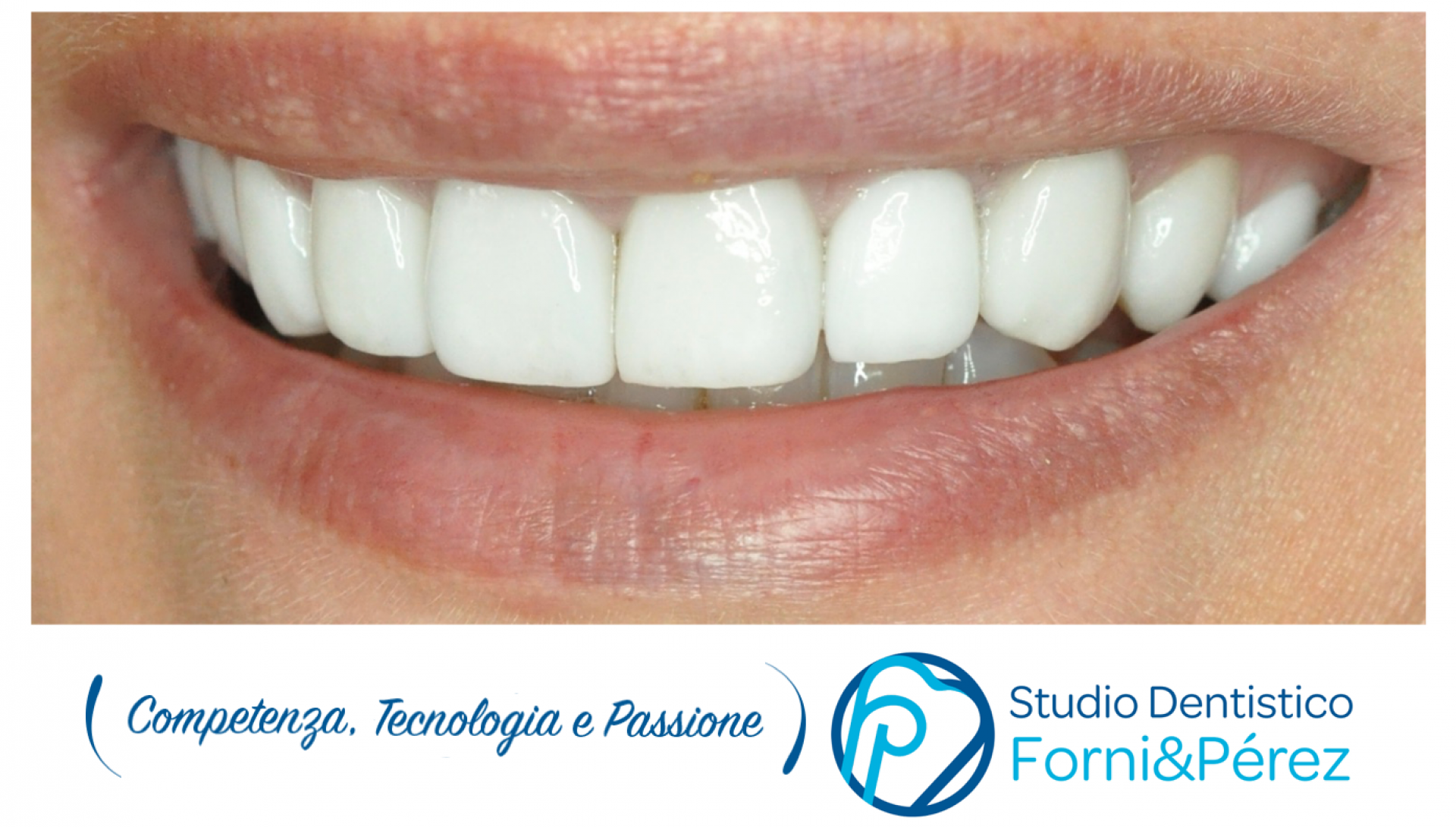 Stampo Per Faccette Dentali Anteriori - Modello In Silicone Autoclavabile - VV Dental